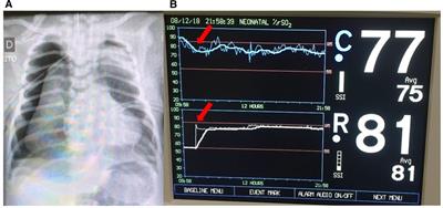 Newer indications for neuromonitoring in critically ill neonates